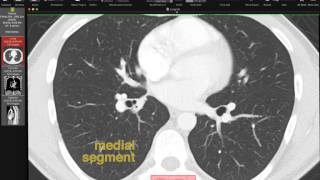 Pulmonary Infarction Chest Xray Hamptons Hump [upl. by Cozza]