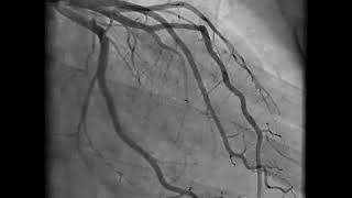 Coronary Angiography  NEJM [upl. by Lemahs530]