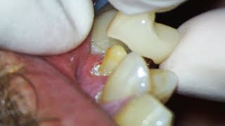 Dental Crown EXPLAINED and how much Tooth Youll Lose [upl. by Ynahpets]