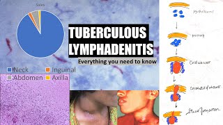 Tuberculous lymphadenitis  stages of cervical lymphadenitis  cold abscess  collar stud abscess [upl. by Staal]