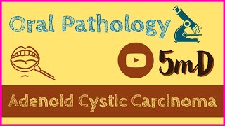 ADENOID CYSTIC CARCINOMA  Salivary gland tumour  Oral Pathology  easy notes [upl. by Leksehcey]