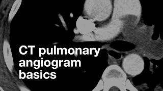 Pulmonary CT Angiogram Basics [upl. by Nnaeiluj942]