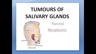 ENT Tumors of Salivary Glands Parotid Neoplasms Benign Malignant Pleomorphic Warthin Cylindroma [upl. by Anirroc]