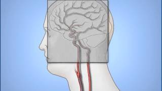 Carotid Duplex Exam [upl. by Nareik818]