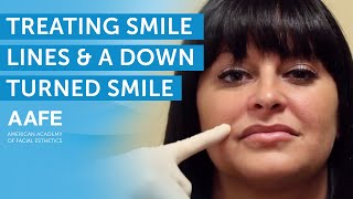 Treating Smile Lines and a Downturned Smile  AAFE [upl. by Riada]