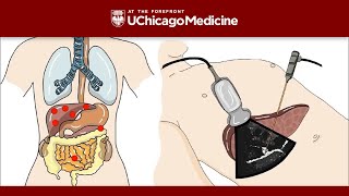 Pancreatic Cancer  Nucleus Health [upl. by Shirah195]