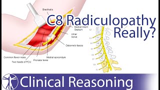 Ulnar Nerve Entrapment mimicking C8 Radiculopathy [upl. by Sitruk679]