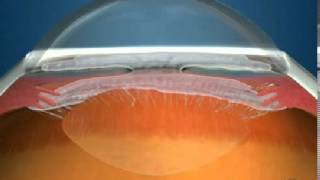 How Fluid Circulates in the Eye [upl. by Lepine]