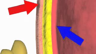 Paracentesis NEJM [upl. by Henke602]