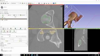 DICOM to STL Conversion Tutorial with Segment Editor [upl. by Enoryt120]