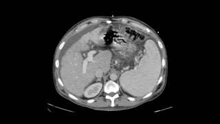 Transjugular Intrahepatic Portosystemic Shunt TIPS [upl. by Meid]