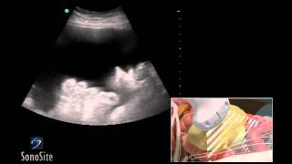 How To Ultrasound Guided Paracentesis Procedure 3D Video [upl. by Yehtomit]