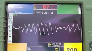 Taquicardia Ventricular Polimorfica 🤯🤯 [upl. by Soiritos932]