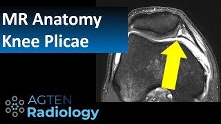 MRI Anatomy of Knee Plicae [upl. by Lateehs]