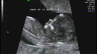 12 weeks 1 day Ultrasound [upl. by Anafetse]