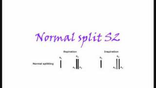 Split of Heart Sounds [upl. by Hairabez]