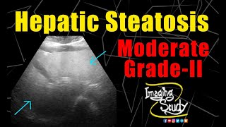 Moderate Hepatic Steatosis  GradeII Fatty Liver  Ultrasound  Case 222 [upl. by Selrac252]