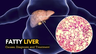 Fatty Liver Causes Signs and Symptoms Diagnosis and Treatment [upl. by Euqinot271]