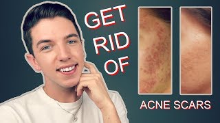 How to Get Rid Rid of Acne Scars Completely [upl. by Todd]