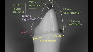 Anterior PFM Preparation  Dr Richard Stevenson [upl. by Fraze73]