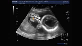 Ultrasound Video showing hydrocephalic fetus [upl. by Aylad162]