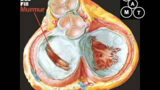 Animated Mitral Stenosis Murmur [upl. by Tade]