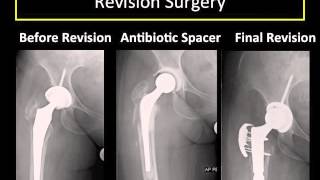 Revision of a Hip Replacement Why How and What to Expect [upl. by Enyleuqcaj914]