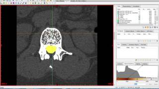 Materialise Mimics and 3Matic Tutorial [upl. by Leummas484]