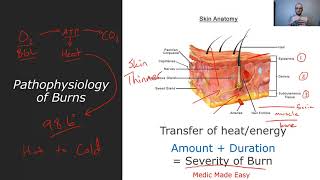 Burns  Pathophysiology Rule of 9s and Parkland Formula fluid resuscitation [upl. by Yorgen]