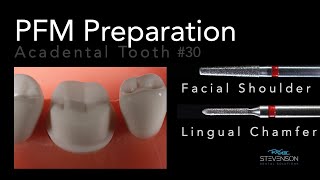 PFM Preparation  Acadental Tooth 30  Dr Richard Stevenson [upl. by Anerda]