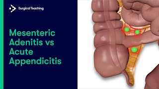 Mesenteric Adenitis vs Appendicitis  How to tell the difference [upl. by Chandra]