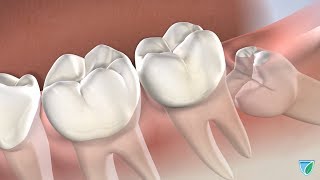 Wisdom Teeth Removal at Upstate Oral Surgery amp Dental Implants Watertown NY [upl. by Etnoled]