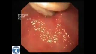 Remove Ascaris Worm Inside Stomach [upl. by Lydnek893]