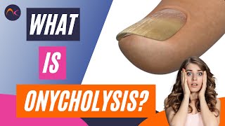 What is Onycholysis Nail lifting and Separation Explained [upl. by Nyre]