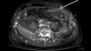 VUMC Paracentesis Complications and Management [upl. by Lazare]