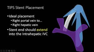 TIPS Stent US Doppler Evaluation [upl. by Capello]