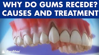 Gum recession  Treatment of gingival retraction © [upl. by Aicilf]