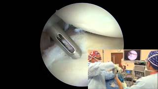 Arthroscopic Posterior Labral Repair  Randy S Schwartzberg MD [upl. by Ardet]