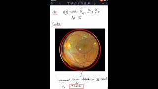 Case 10 Central Serous Chorio Retinopathy CSCR  A complete review [upl. by Hicks500]