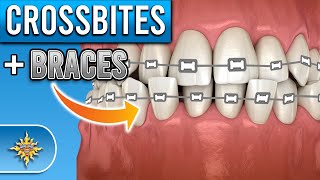 How Do BRACES Fix Crossbites [upl. by Cartwell]