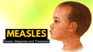 Measles To vaccinate or not [upl. by Griffy]