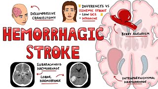 Acute Ischemic Stroke Etiology Pathophysiology Clinical Features Diagnostics Treatment [upl. by Oilut]