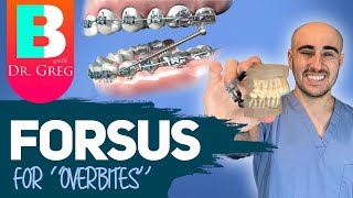 Braces Forsus for Overbite Overjet Correction [upl. by Icrad237]