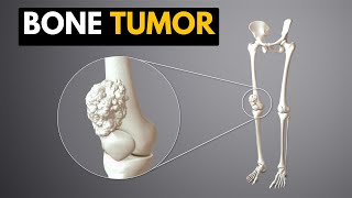 Bone Tumor Causes Signs and Symptoms Diagnosis and Treatment [upl. by Kciderf]