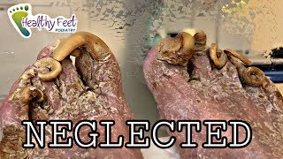 Cutting Neglected Nails EXTREME THICK TOENAILS [upl. by Ttirrej]