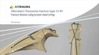 Olecranon  Fracture Fixation Using Tension Band Wiring [upl. by Nivalc]