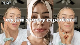 UNDERBITE JAW SURGERY  vlog  recovery days 114  before amp after [upl. by Yelmene]