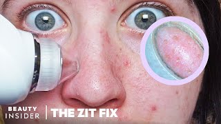 Pore Vacuum For Blackheads Has BuiltIn Microscope  The Zit Fix [upl. by Minton]