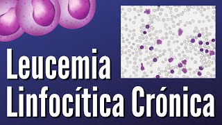 Leucemia Linfocítica Crónica [upl. by Shaine907]