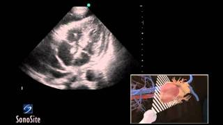 How To Ultrasound Guided Pericardiocentesis Procedure 3D Video [upl. by Madra]